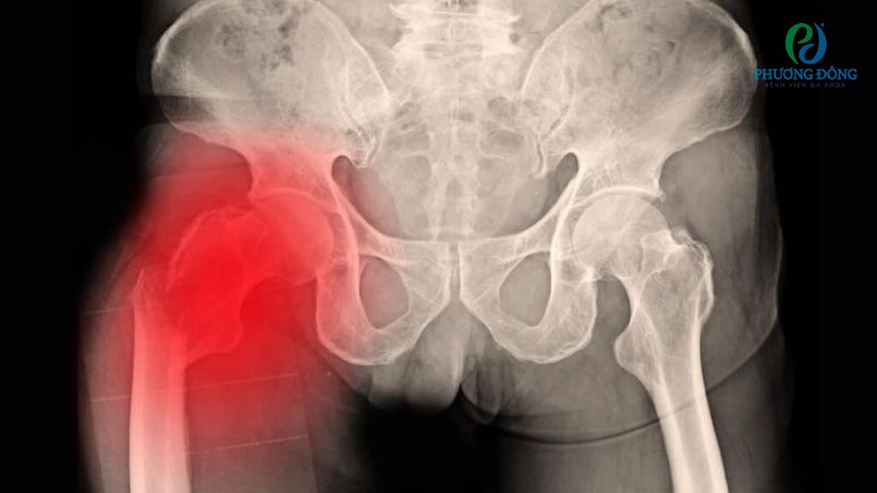 Gãy xương chậu không ảnh hưởng đến khả năng mang thai của người mẹ