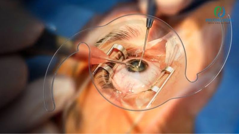 Mổ cườm mắt không cần nằm viện qua đêm, bệnh nhân có thể tự chăm sóc tại nhà