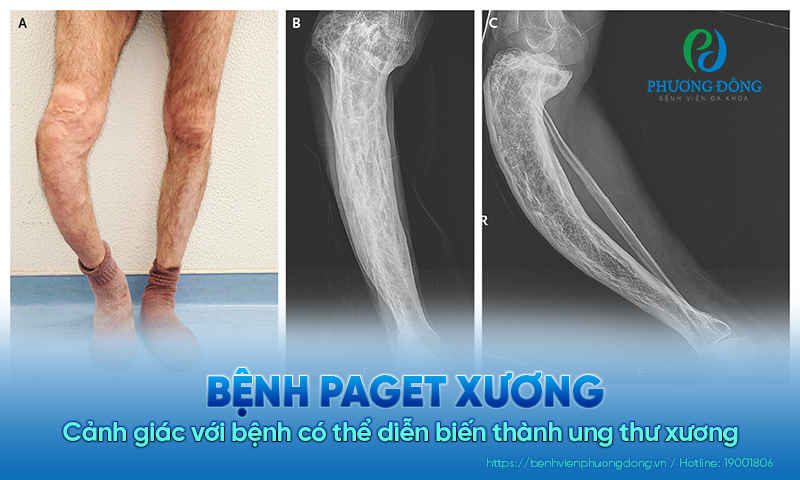 Cảnh giác với bệnh Paget xương có thể diễn biến thành ung thư xương 