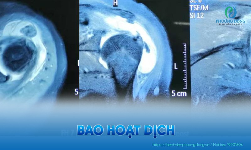 Bao hoạt dịch: Chức năng và các bệnh lý có khả năng ảnh hưởng
