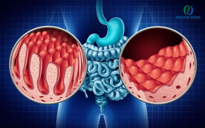 Bệnh celiac: Nguyên nhân, triệu chứng và phương pháp điều trị bệnh