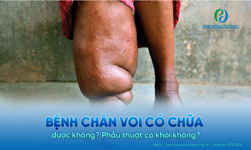 Bệnh chân voi có chữa được không? Phẫu thuật có khỏi không? Bệnh chân voi có chữa được không? Phẫu thuật có khỏi không?