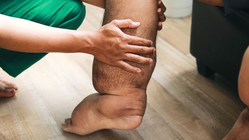 Bệnh chân voi có thể kiểm soát tốt nếu được phát hiện sớm