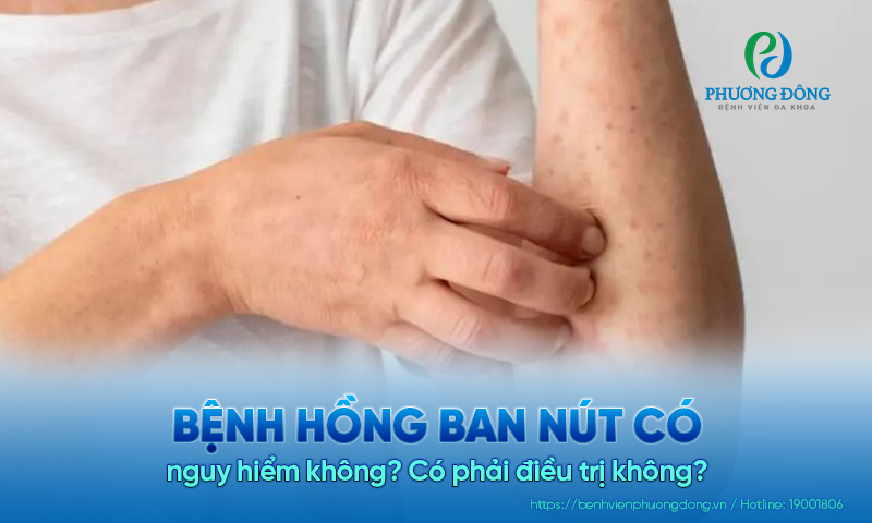 Bệnh hồng ban nút có nguy hiểm không? Có phải điều trị không?
