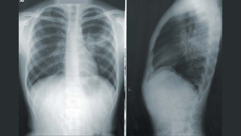 Bệnh nhân gãy xương không nên uống bia
