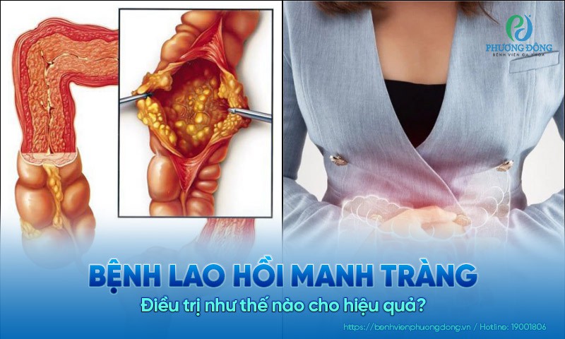 Bệnh lao hồi manh tràng được điều trị như thế nào cho hiệu quả?