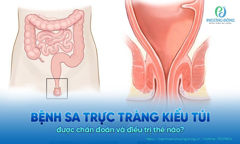 Bệnh sa trực tràng kiểu túi được chẩn đoán và điều trị thế nào?