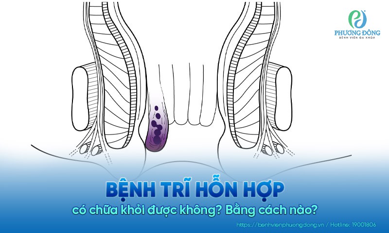 Bệnh trĩ hỗn hợp có chữa khỏi được không? Bằng cách nào?