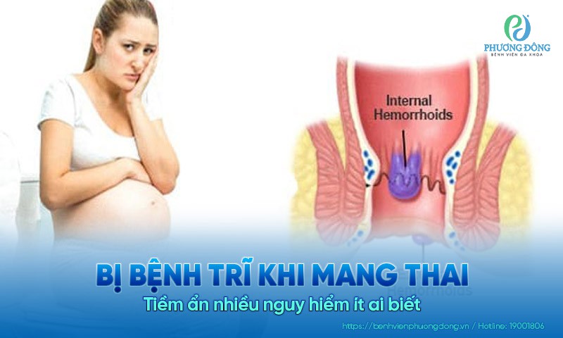 Bị bệnh trĩ khi mang thai: Tiềm ẩn nhiều nguy hiểm ít ai biết