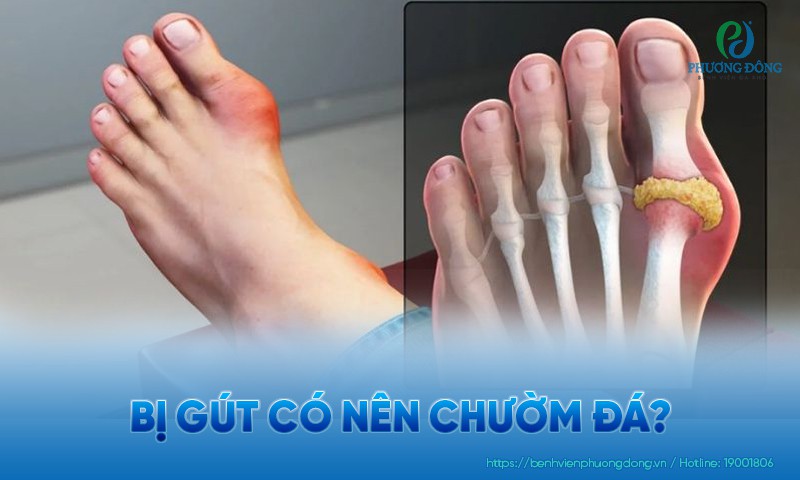 Bị gút có nên chườm đá không? Những lưu ý khi chườm đá điều trị