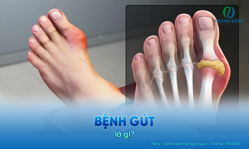 Bệnh nhân gút thường đối mặt với các cơn đau nhức khó chịu