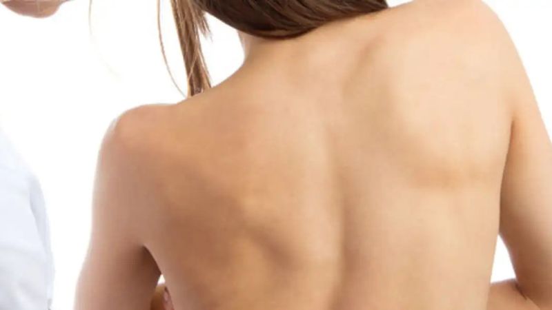 Dạng cong vẹo cột sống này khiến vai không đều và đầu người bệnh bị lệch sang 1 bên