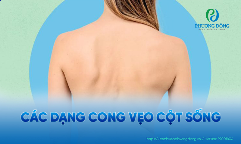 Cong vẹo cột sống có thể chia ra thành nhiều hình thức khác nhau