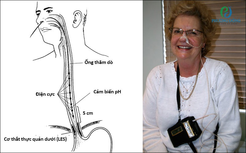 Phương pháp theo dõi pH thực quản truyền thống