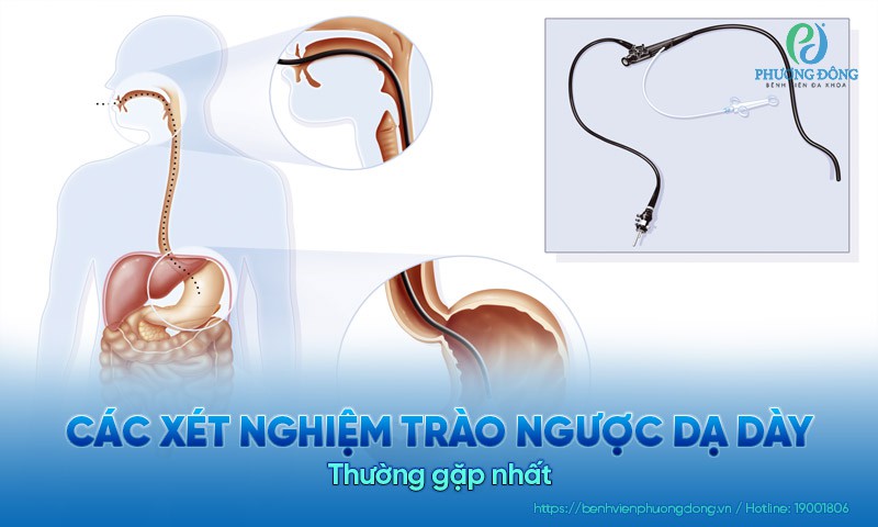 Tổng hợp các xét nghiệm trào ngược dạ dày thường gặp nhất