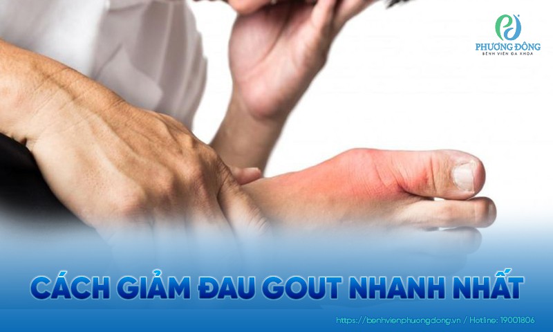 Cách giảm đau gout nhanh nhất và an toàn tại nhà