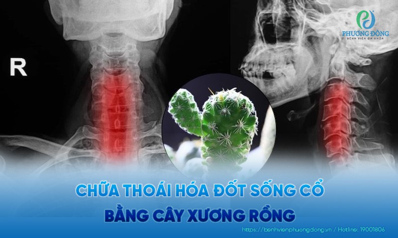 Chữa thoái hóa đốt sống cổ bằng cây xương rồng sao cho hiệu quả