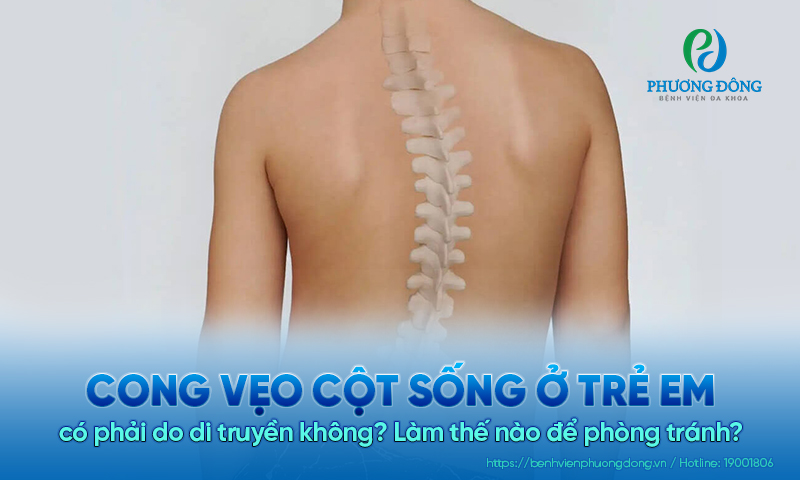Cong vẹo cột sống ở trẻ em có phải do di truyền không? Làm thế nào để phòng tránh?