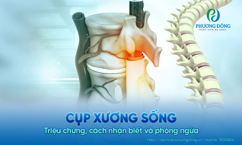 Cụp xương sống: Triệu chứng, cách nhận biết và phòng ngừa