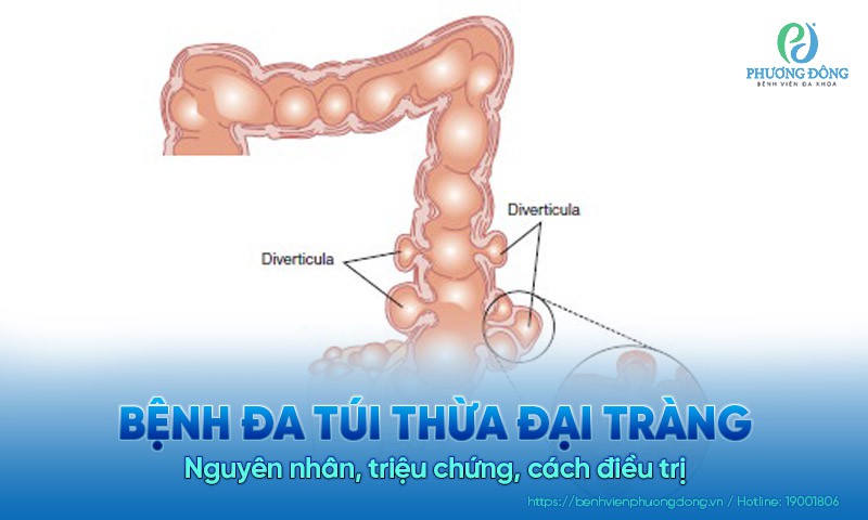 Đa túi thừa đại tràng: Nguyên nhân, triệu chứng, cách điều trị