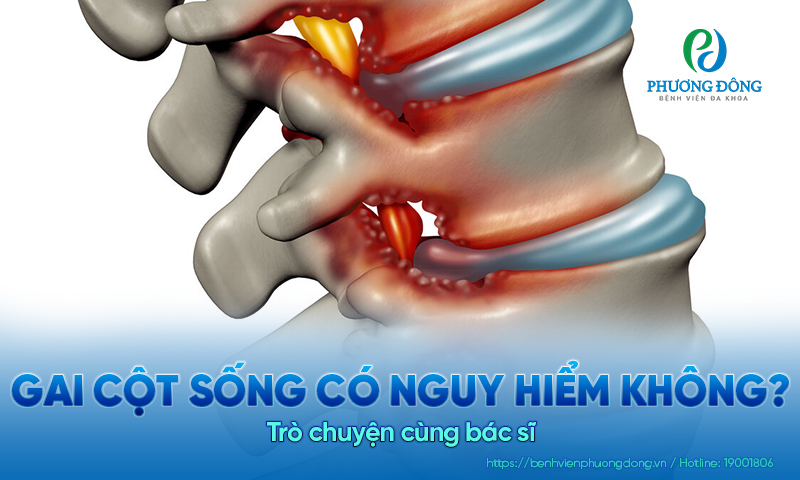 Trò chuyện cùng bác sĩ: Gai cột sống có nguy hiểm không? Trò chuyện cùng bác sĩ: Gai cột sống có nguy hiểm không?