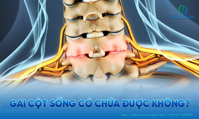Gai cột sống có chữa được không? Các phương pháp điều trị