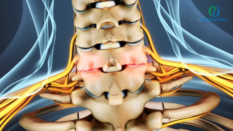 Gai cột sống là thuật ngữ chỉ phần xương phát triển thêm trên đốt sống