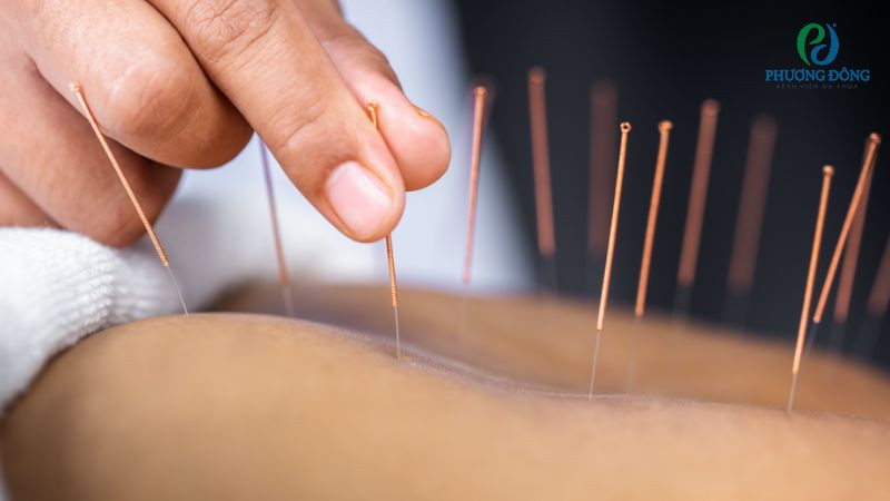 Kết hợp vật lý trị liệu chữa trị gai cột sống