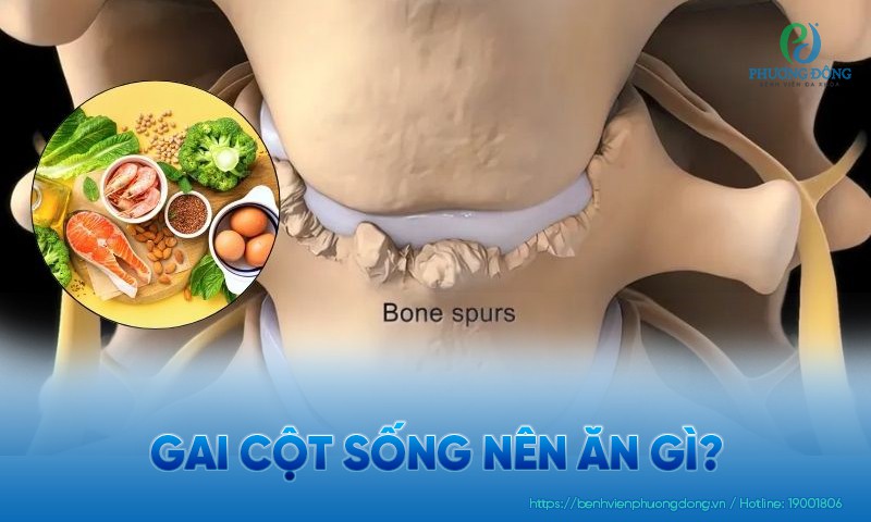 Gai cột sống nên ăn gì và không nên ăn gì?