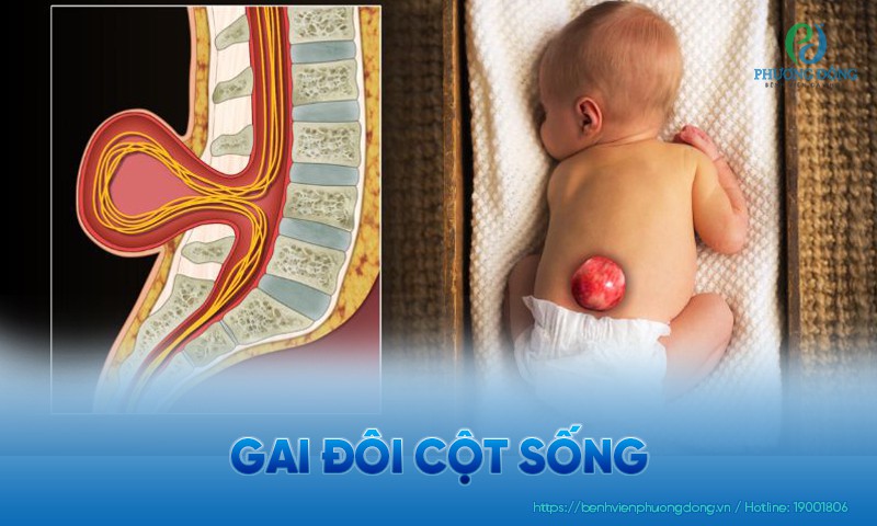 Gai đôi cột sống: Triệu chứng, nguyên nhân và hướng điều trị