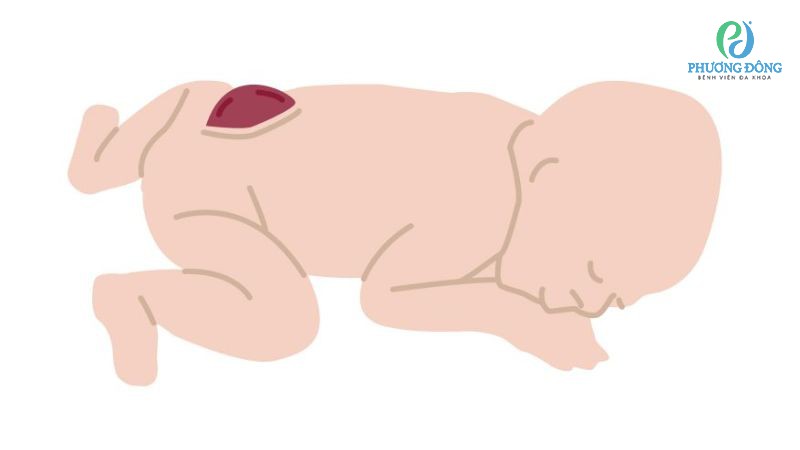 Một số triệu chứng điển hình của gai đôi cột sống lưng