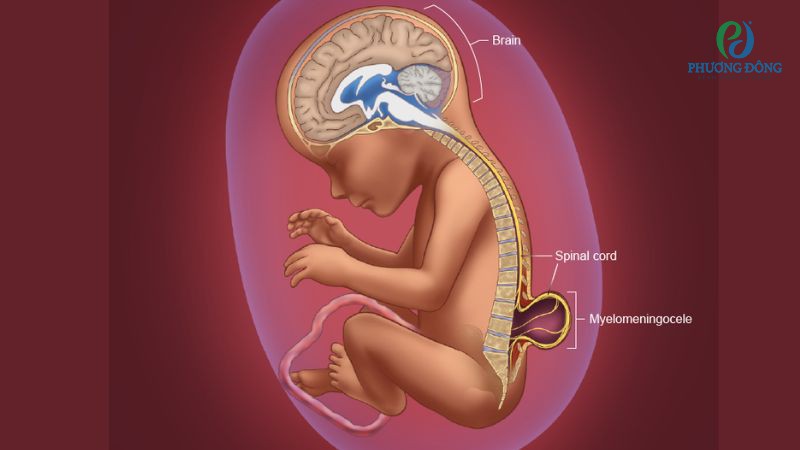 Yếu tố làm tăng nguy cơ trẻ mắc chứng tật nứt cột sống