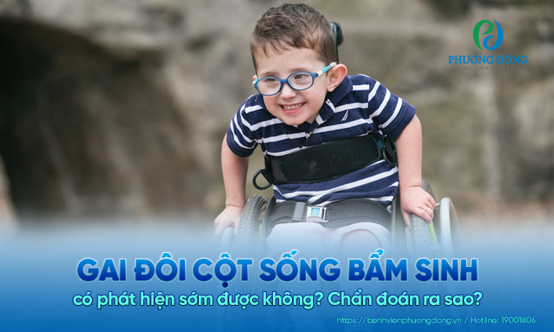 Gai đôi cột sống bẩm sinh có phát hiện sớm được không? Chẩn đoán ra sao?