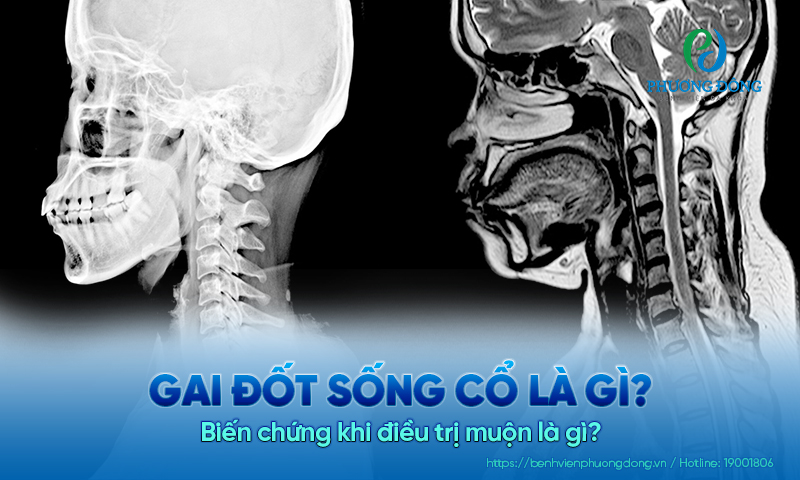 Gai đốt sống cổ là gì? Biến chứng khi điều trị muộn là gì?