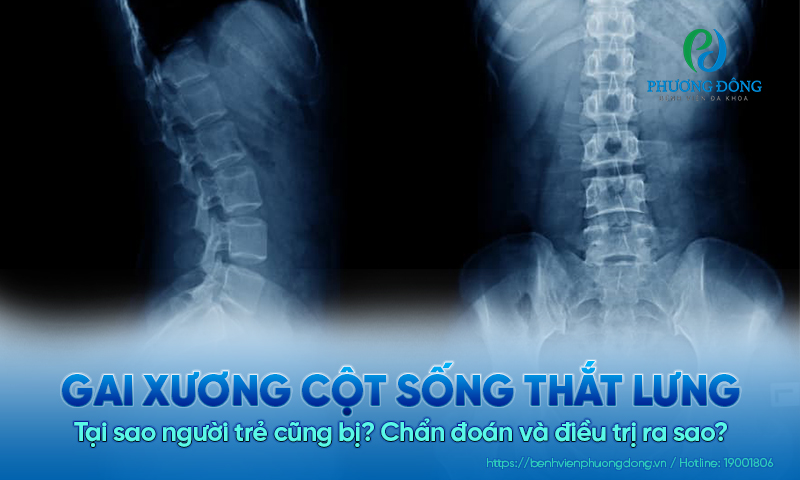 Tại sao người trẻ cũng bị gai xương cột sống thắt lưng? Chẩn đoán và điều trị ra sao?