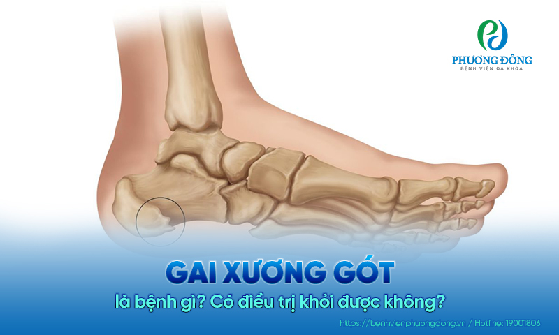 Gai xương gót là bệnh gì? Có điều trị khỏi được không?