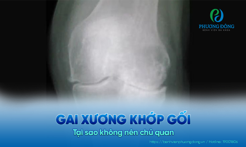 Tại sao không nên chủ quan khi bị gai xương khớp gối? 