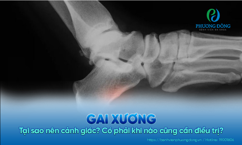 Tại sao nên cảnh giác với gai xương? Có phải khi nào cũng cần điều trị?