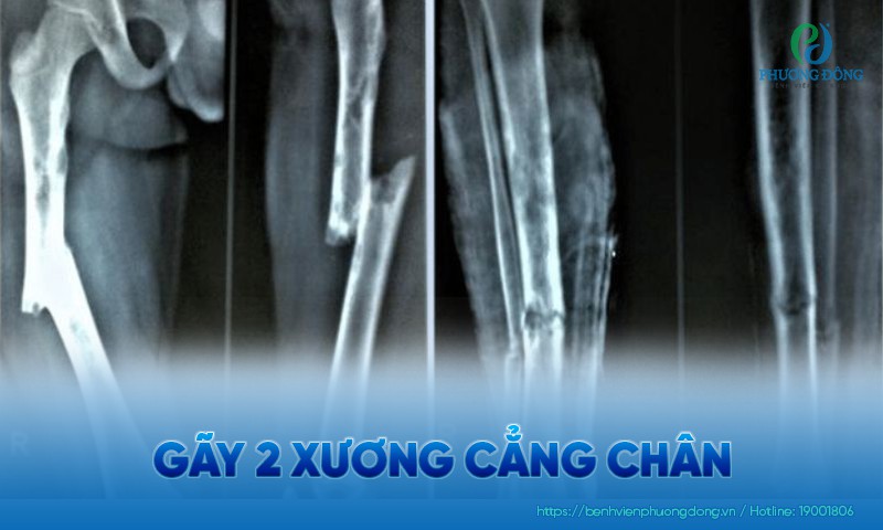 Gãy 2 xương cẳng chân: Nguyên nhân, triệu chứng và điều trị