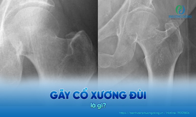 Gãy cổ xương đùi: Nguyên nhân, triệu chứng và cách điều trị