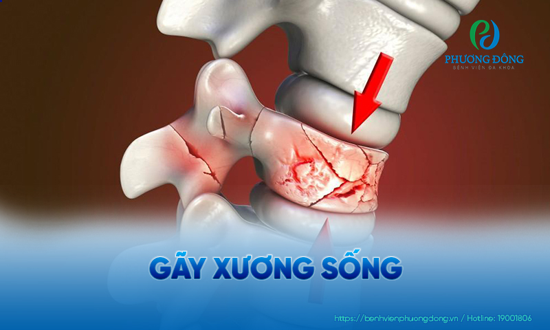 Gãy xương sống có phổ biến không? Điều trị như thế nào?