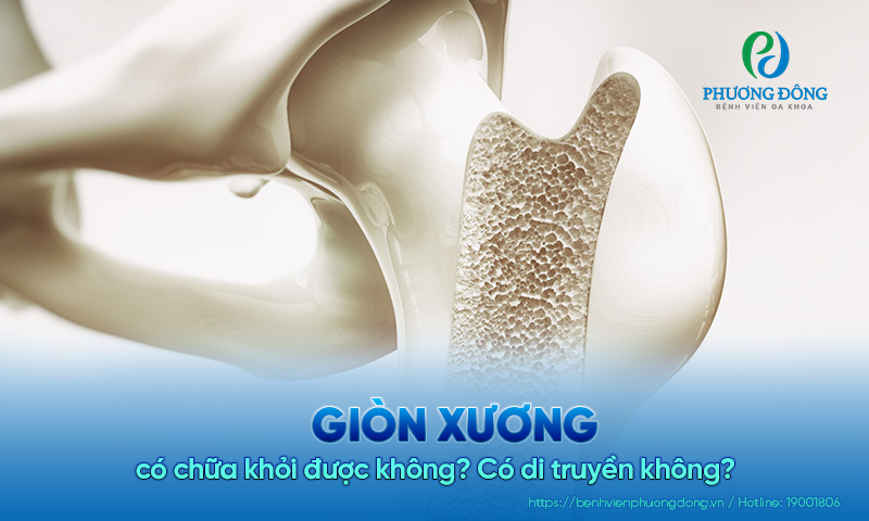 Giòn xương có chữa khỏi được không? Có di truyền không?