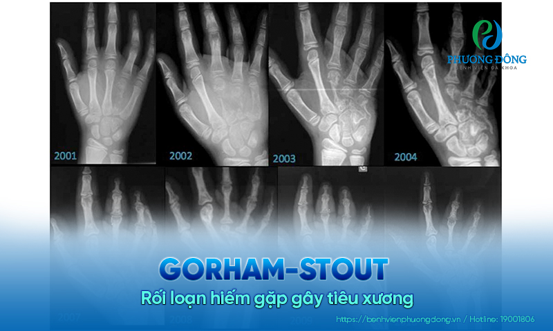 Gorham-Stout - Rối loạn hiếm gặp gây tiêu xương