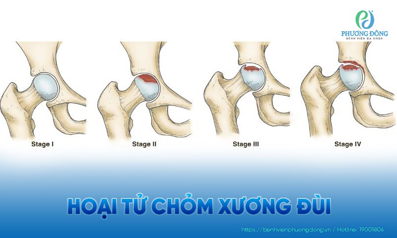 Hoại tử chỏm xương đùi: Nguyên nhân, triệu chứng và điều trị