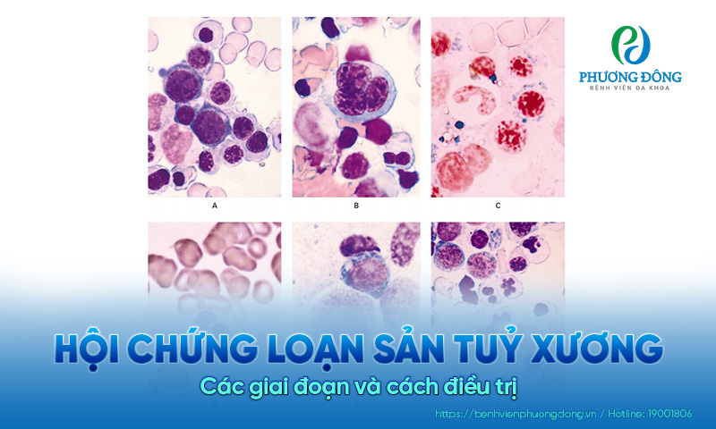 Hội chứng loạn sản tủy xương: Các giai đoạn và cách điều trị 