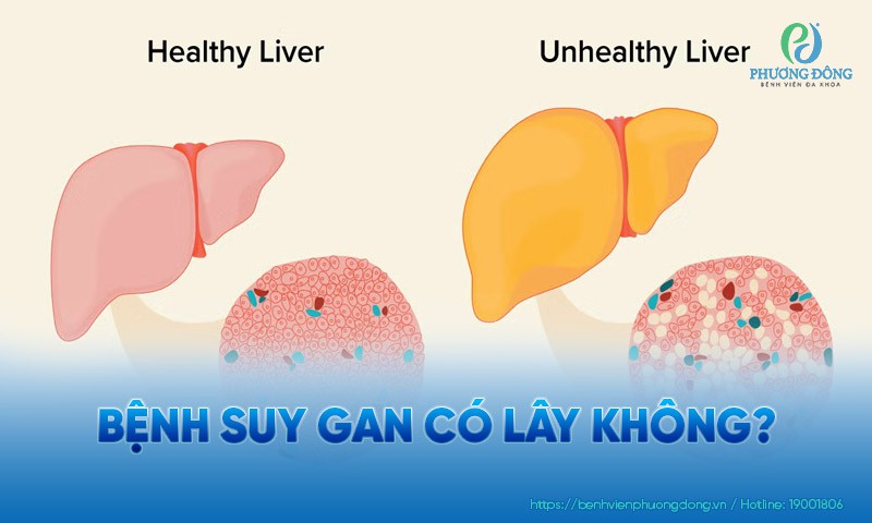 Bệnh suy gan có lây không?