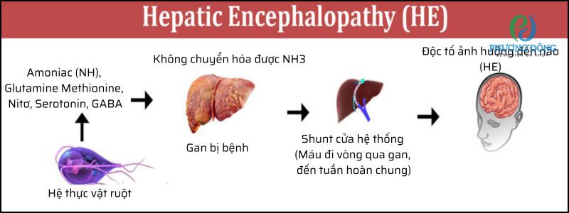 Quá trình phát triển của bệnh não gan
