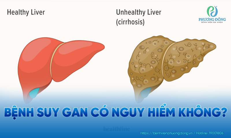 Bệnh suy gan có nguy hiểm không?