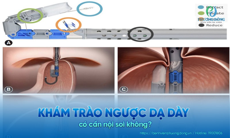 Khám trào ngược dạ dày có cần nội soi không?