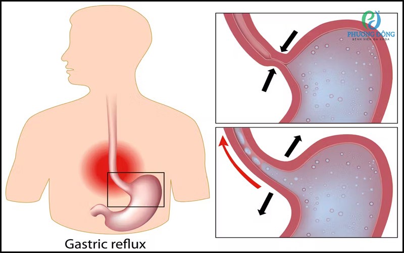 Trào ngược dạ dày thực quản không phải là một lây truyền